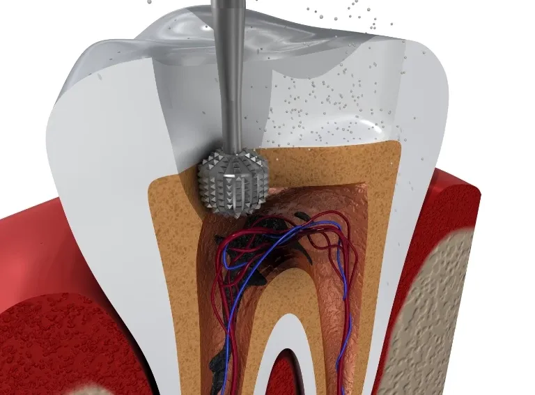 endodoncja